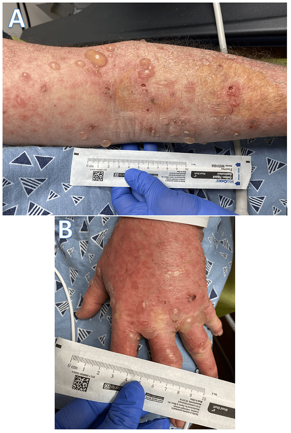 Warning: Patient's Itchy Swollen Skin Patches Were Not Infectious Cellulitis  | MedPage Today, image size:986x1467