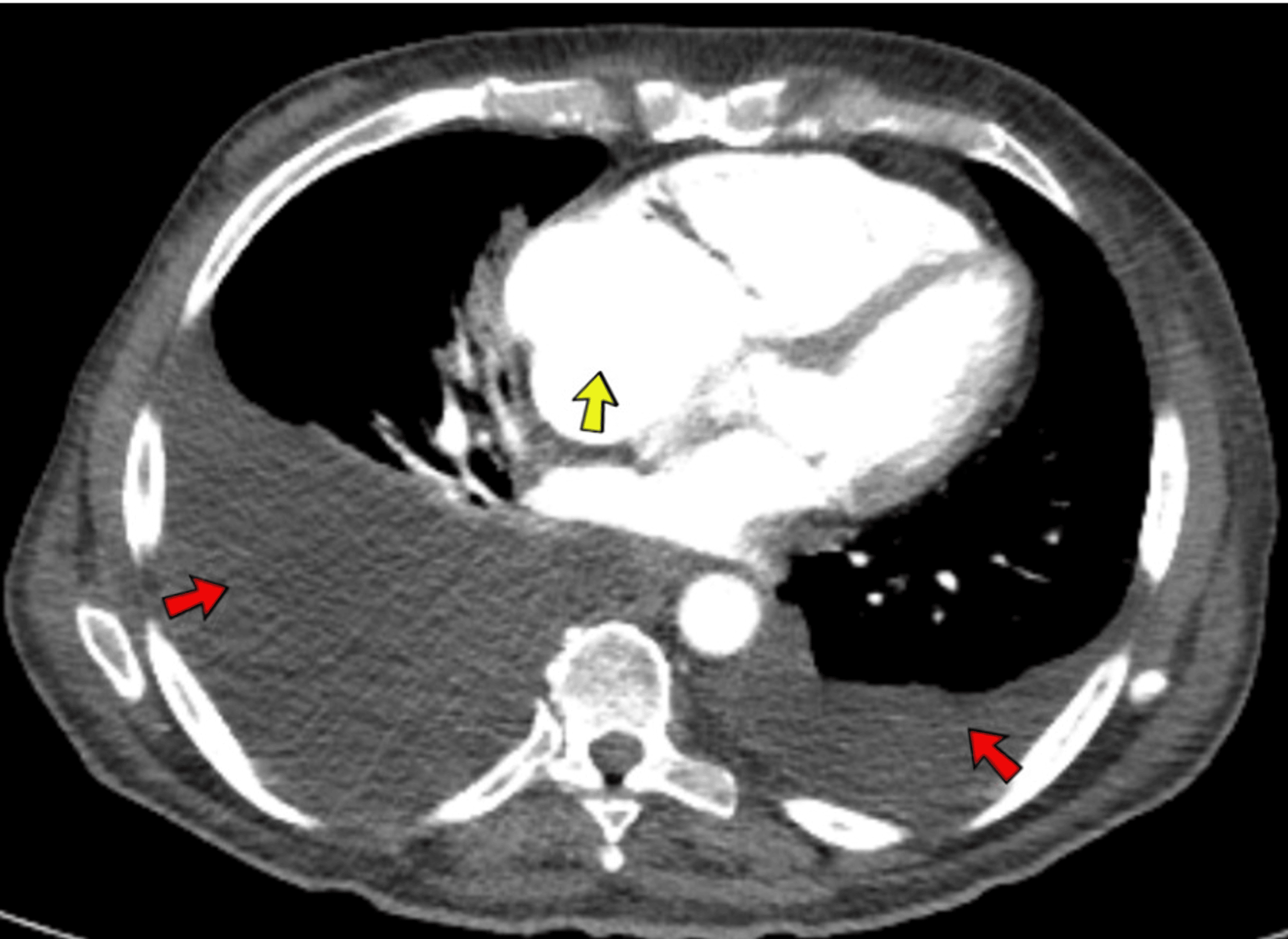 Carcinoid Heart Syndrome With Metastatic LowGrade Neuroendocrine Tumor