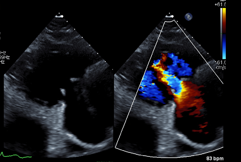 Carcinoid Heart Syndrome With Metastatic LowGrade Neuroendocrine Tumor