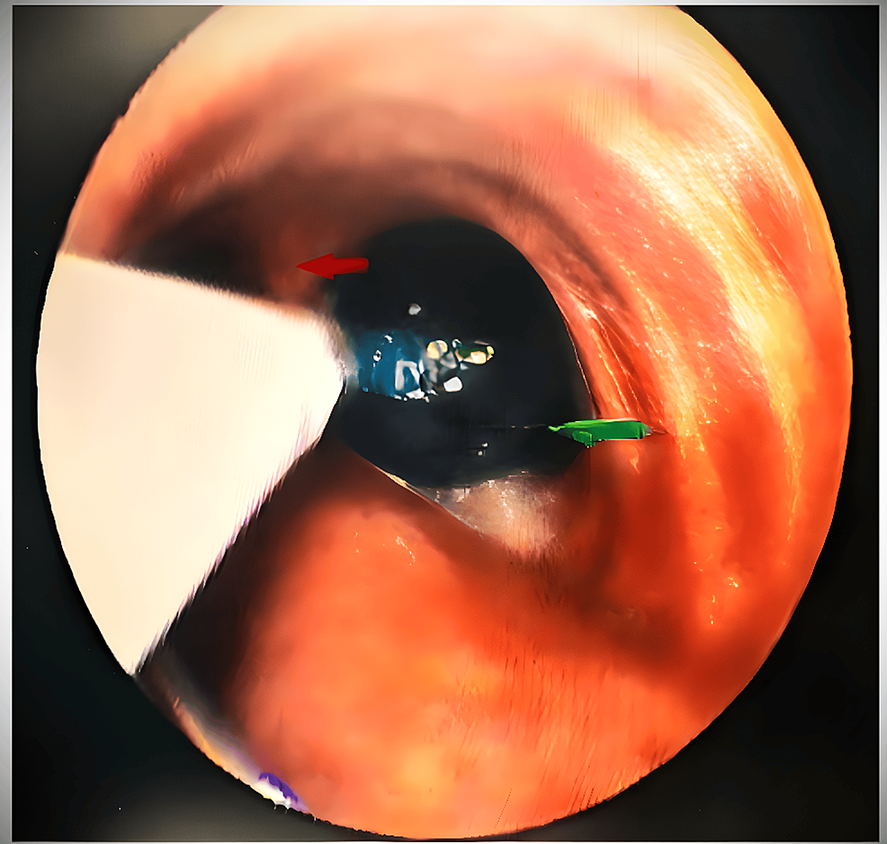 Y-shaped-tip-of-EZ-bronchial-blocker,-stranded-on-carina.-The-red-arrow-points-to-the-carina,-and-the-green-arrow-points-to-the-inflated-cuff-of-the-right-arm-of-the-bronchial-blocker-inside-the-right-bronchus.