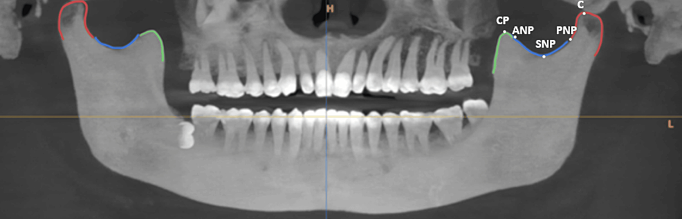 Distinctive Anatomical Patterns of the Mandibular Coronoid Process ...