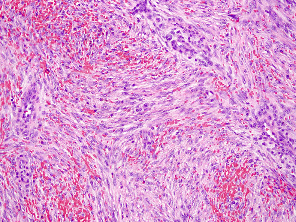 Desmoid Tumor of the Rectus Abdominis Muscle A Case Report Cureus