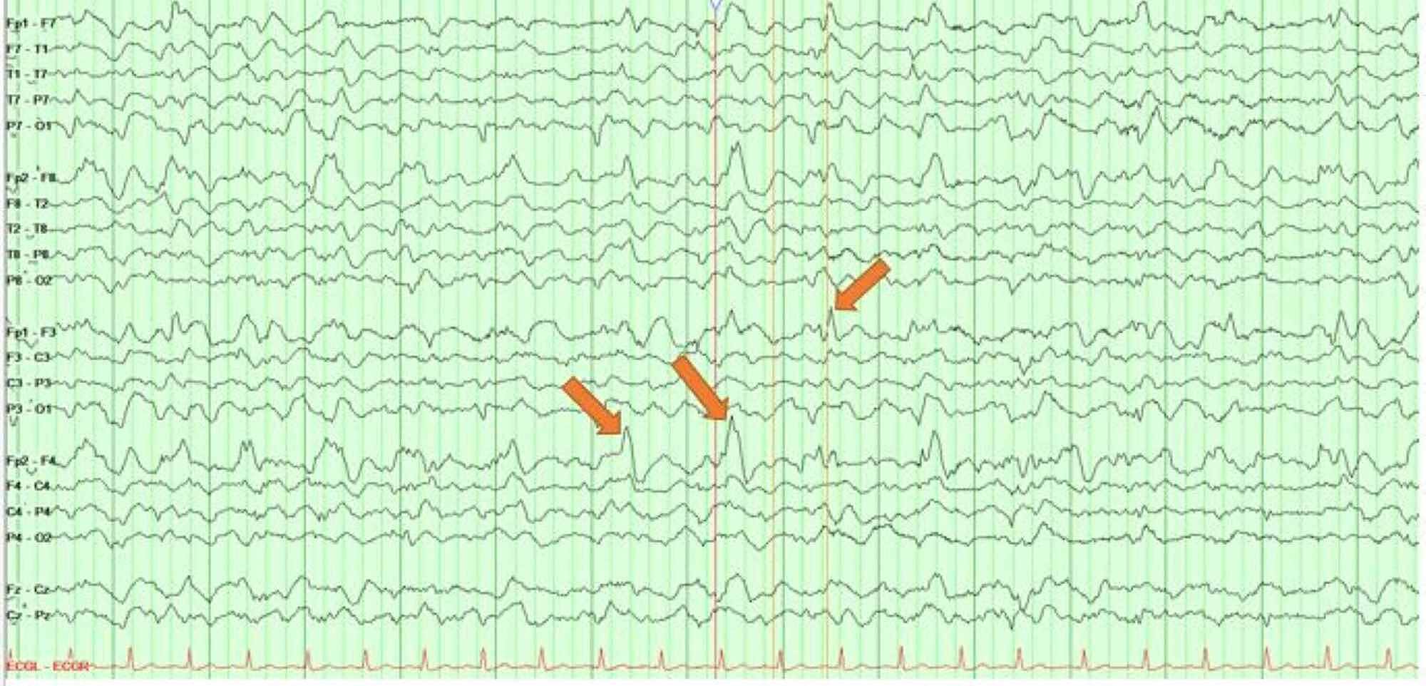 Cureus CreutzfeldtJakob Disease Presenting as Posterior Reversible