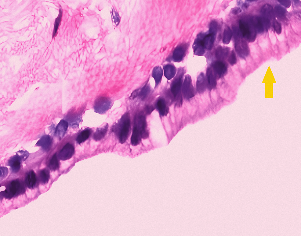 Histopathology-image-of-the-bronchial-cyst-(yellow-arrow-showing-columnar-epithelium)