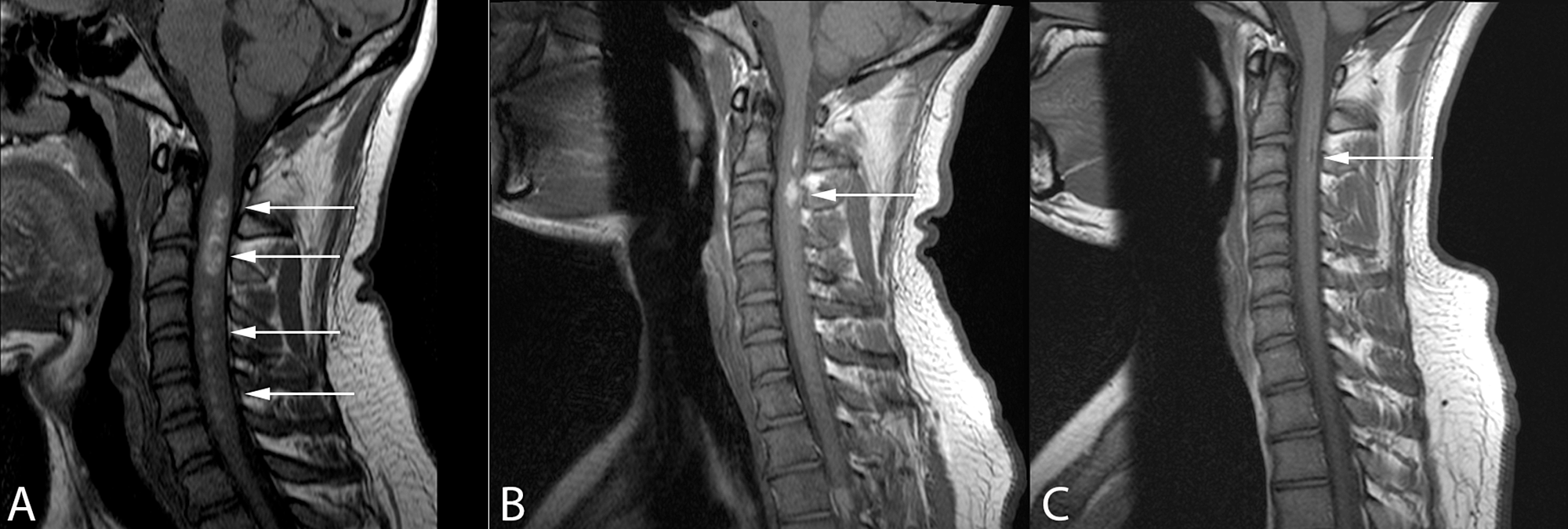 Cureus | Spontaneous Regression of a Symptomatic Intramedullary Spinal ...