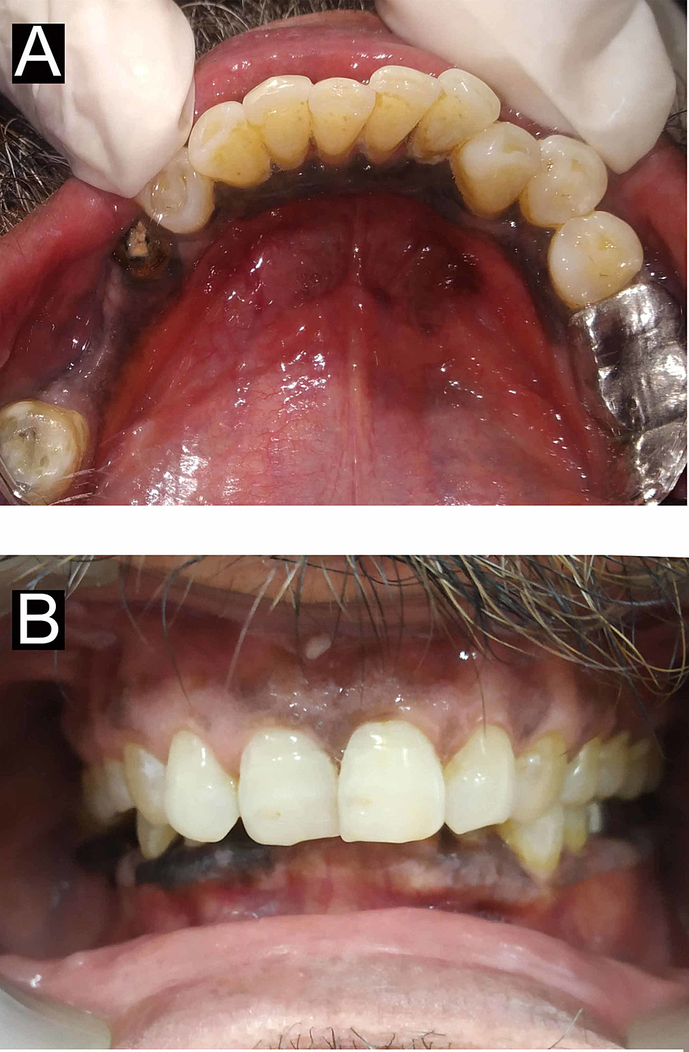 A Unique Presentation of Gingival Melanoacanthoma: Case Report and Review  of Literature