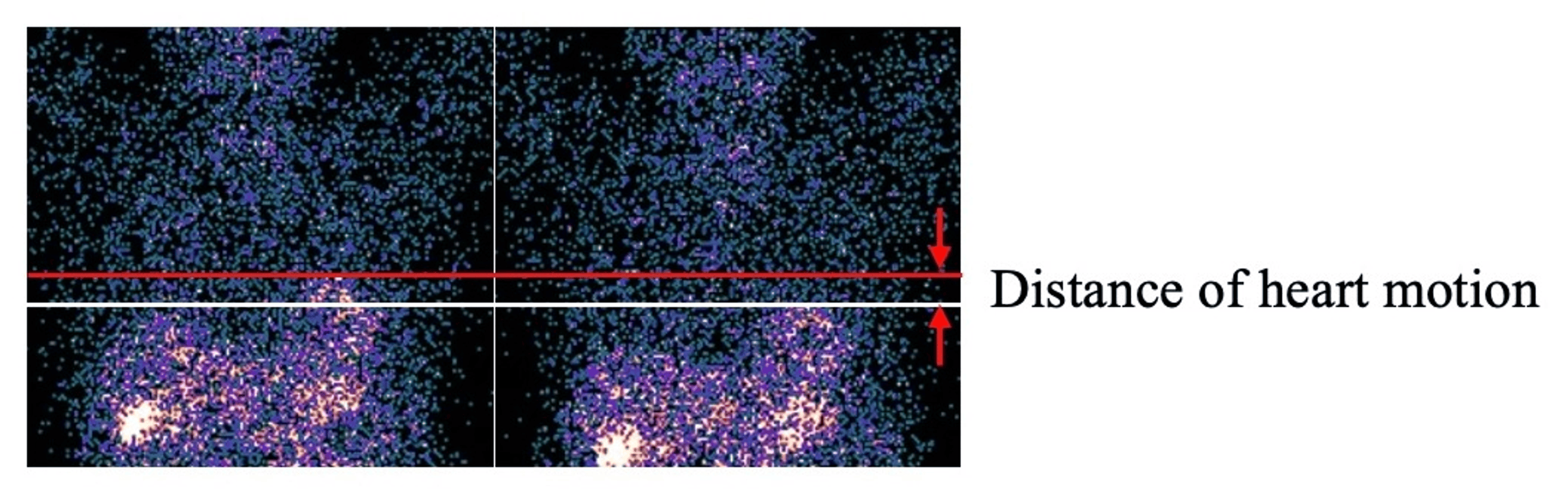 Efficacy of a Novel Respiratory Motion Reduction Block in Reducing Motion Artifact on Myocardial