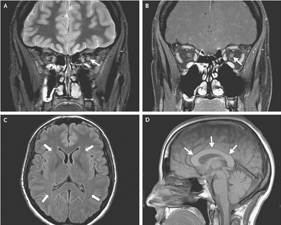 Leber Hereditary Optic Neuropathy Case Report and Literature Review Cureus