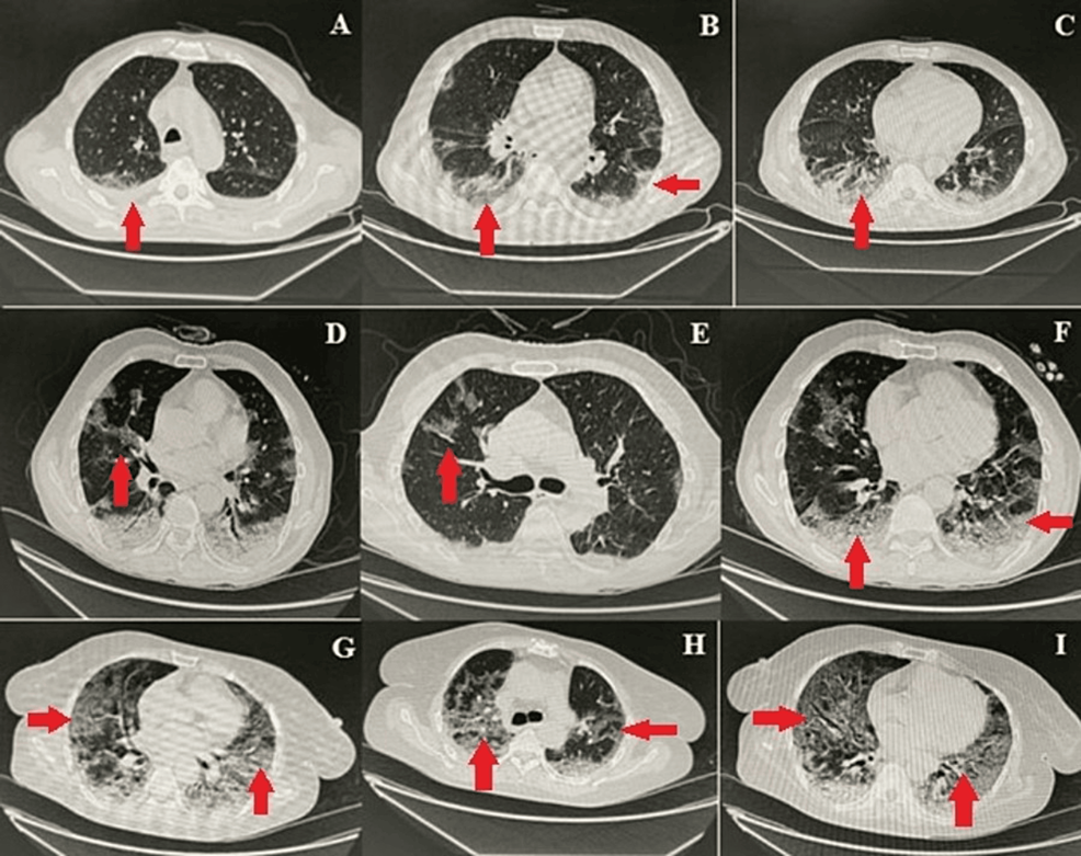 Representative-chest-CT-images-showing-COVID-19-pneumonia Representative-chest-CT-images-showing-COVID-19-pneumonia