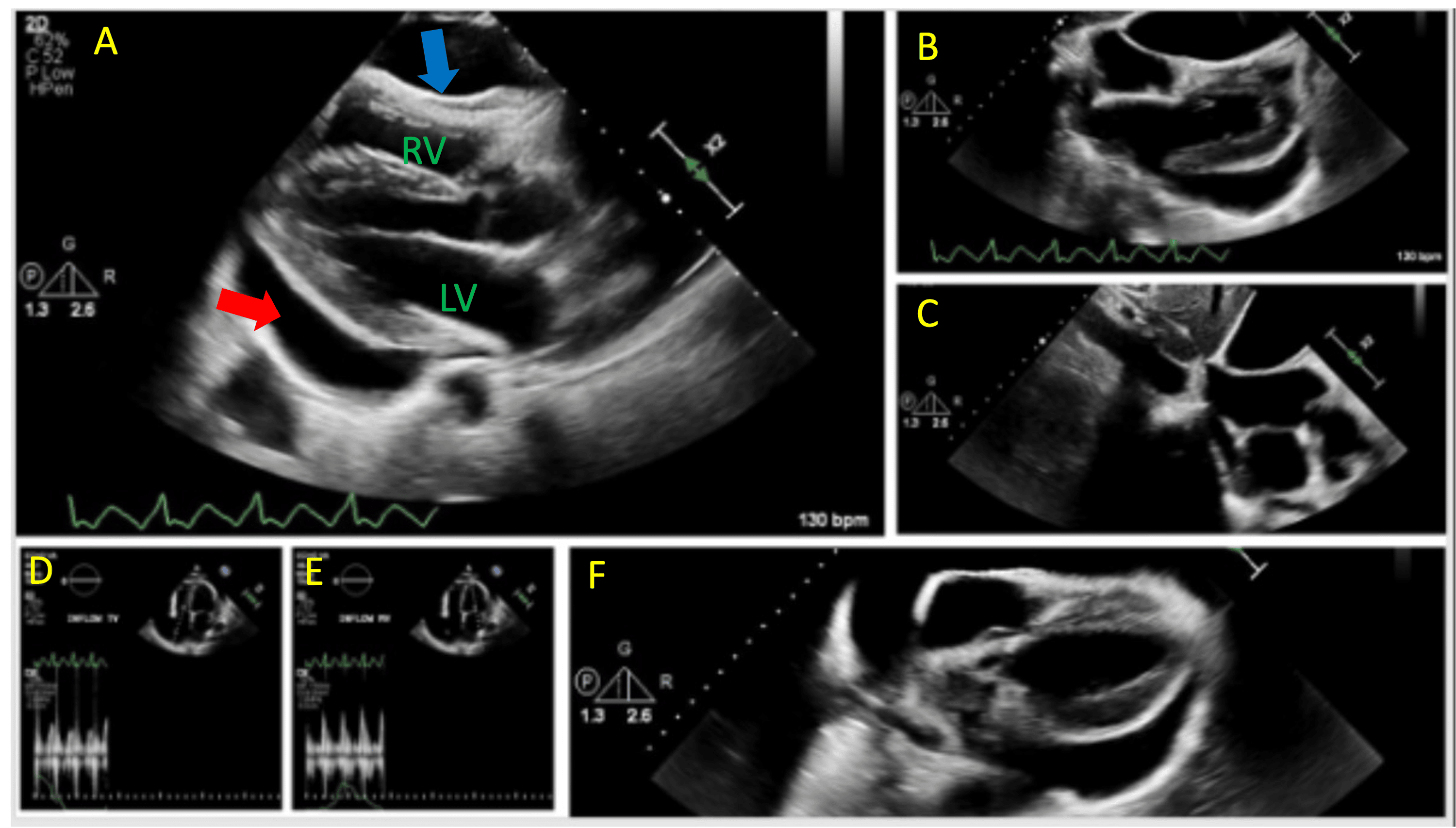 Cureus | Cardiac Angiosarcoma Presenting as Large Pericardial Effusion ...