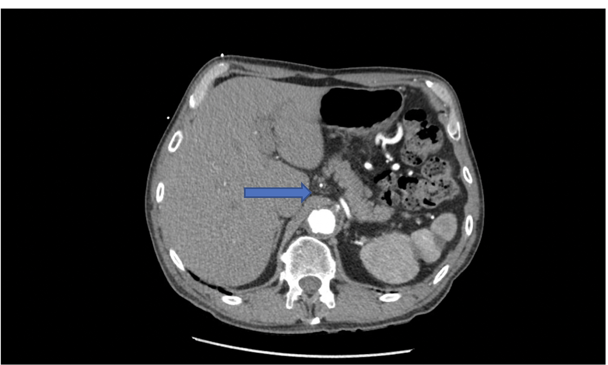 Median arcuate ligament syndrome что это