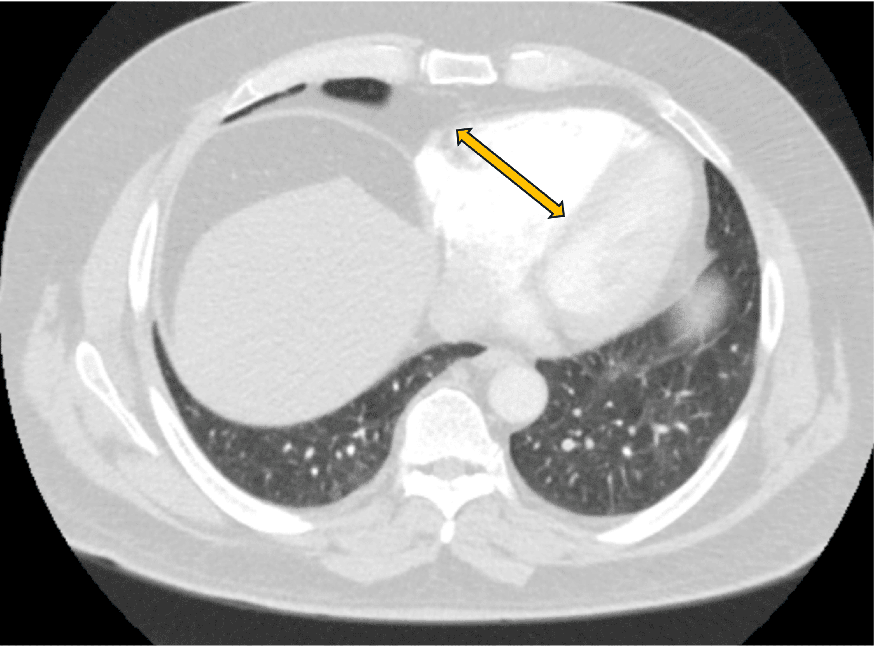 Persistent Peril Recurrent Deep Vein Thrombosis and Pulmonary Embolism