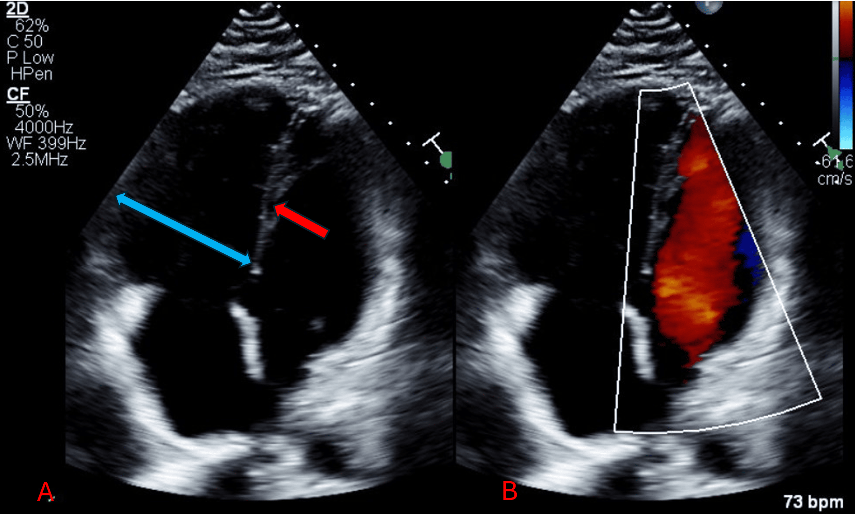 Persistent Peril Recurrent Deep Vein Thrombosis and Pulmonary Embolism