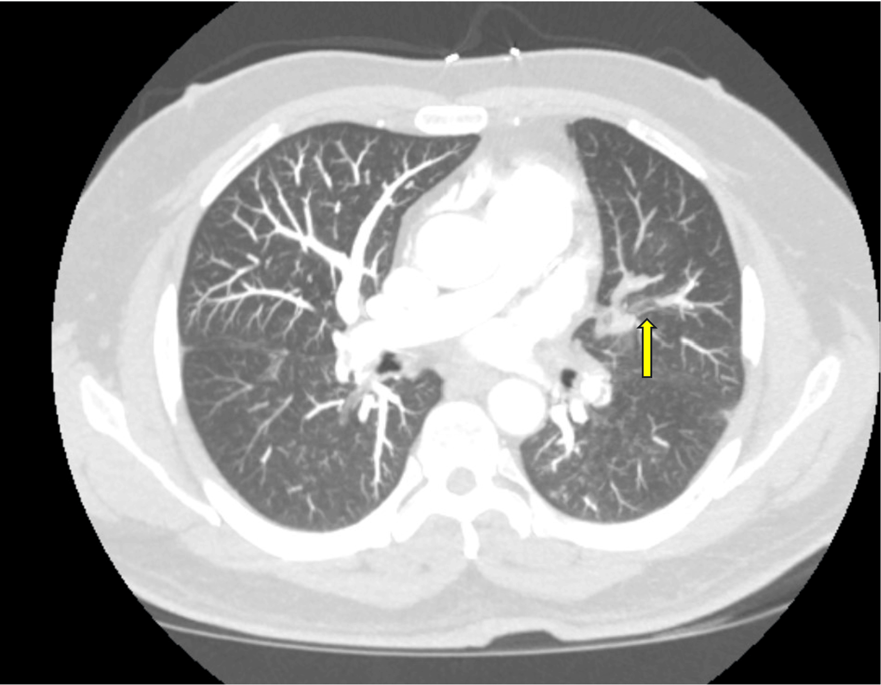 Persistent Peril Recurrent Deep Vein Thrombosis and Pulmonary Embolism