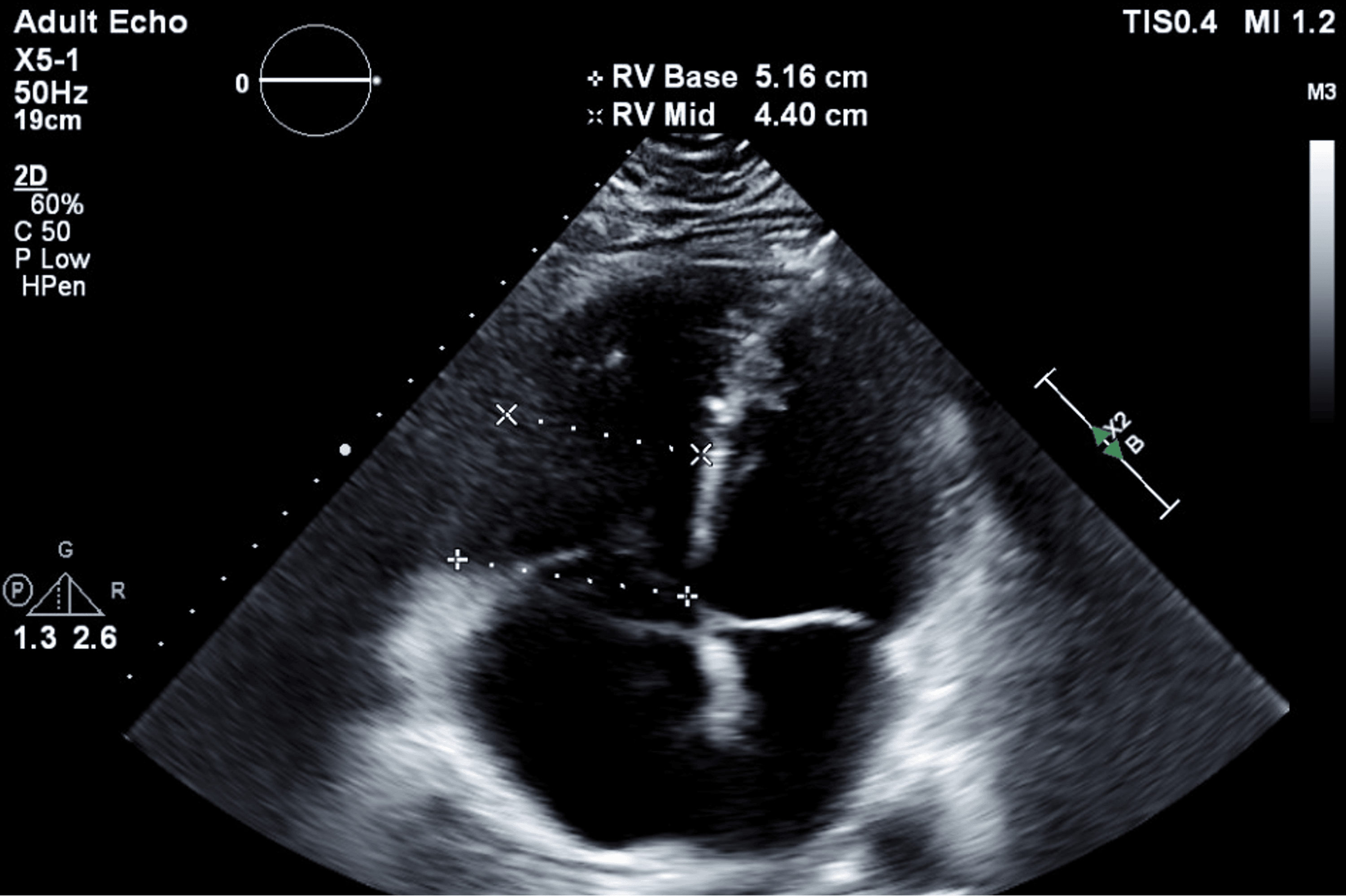 Persistent Peril Recurrent Deep Vein Thrombosis and Pulmonary Embolism
