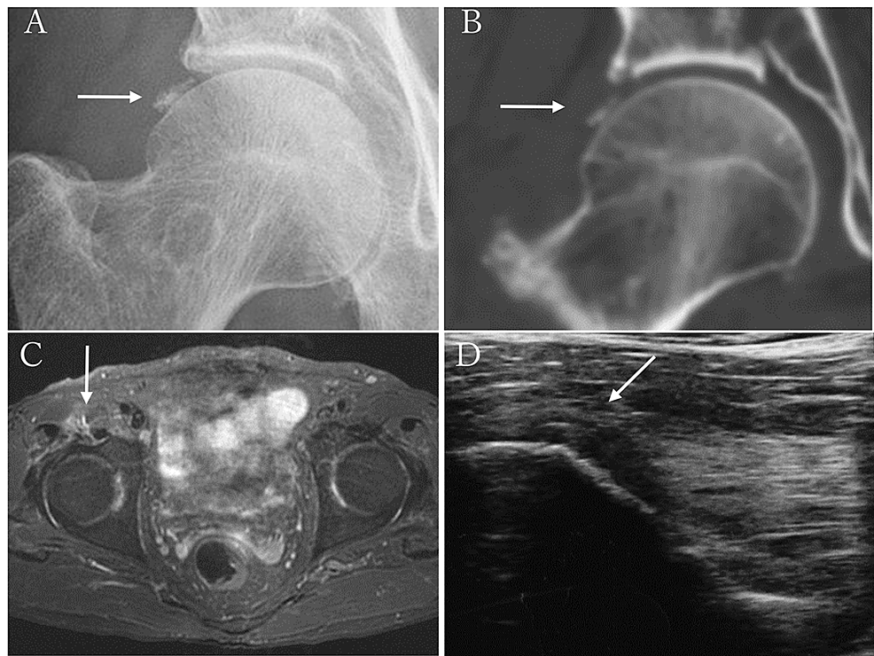 Administration Of Cimetidine For Calcific Tendinitis Of The Rectus ...