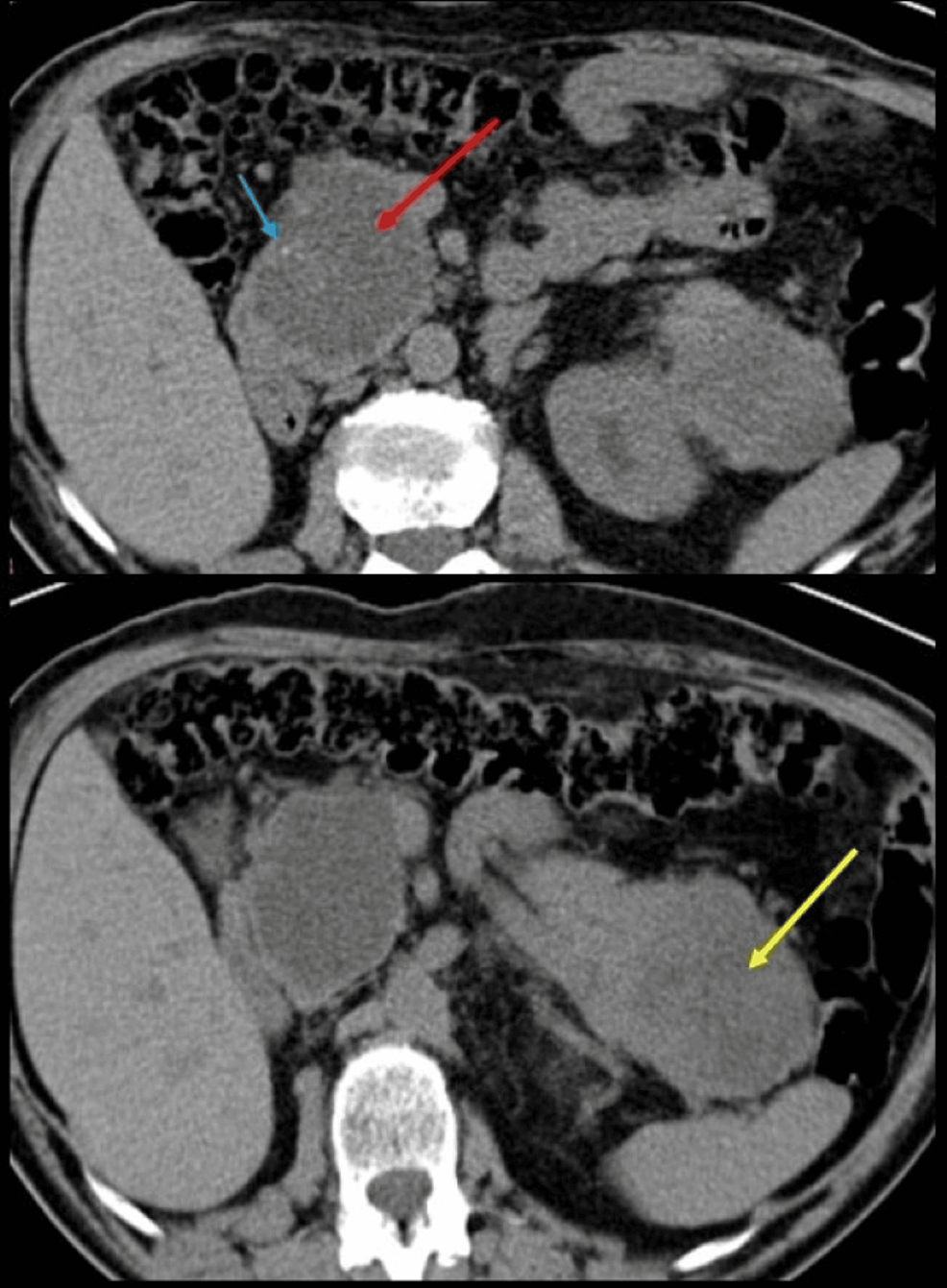 a-serous-cystic-tumor-and-a-pancreatic-neuroendocrine-tumor-in-the-same