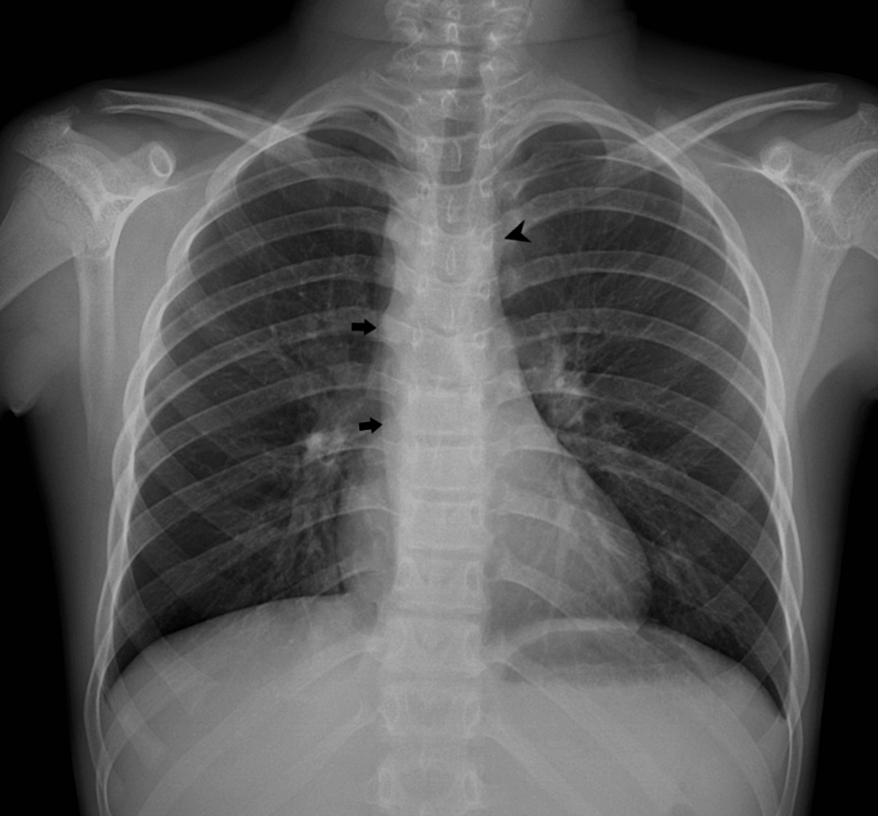 Right-Sided Aortic Arch With Isolated Left Subclavian Artery ...