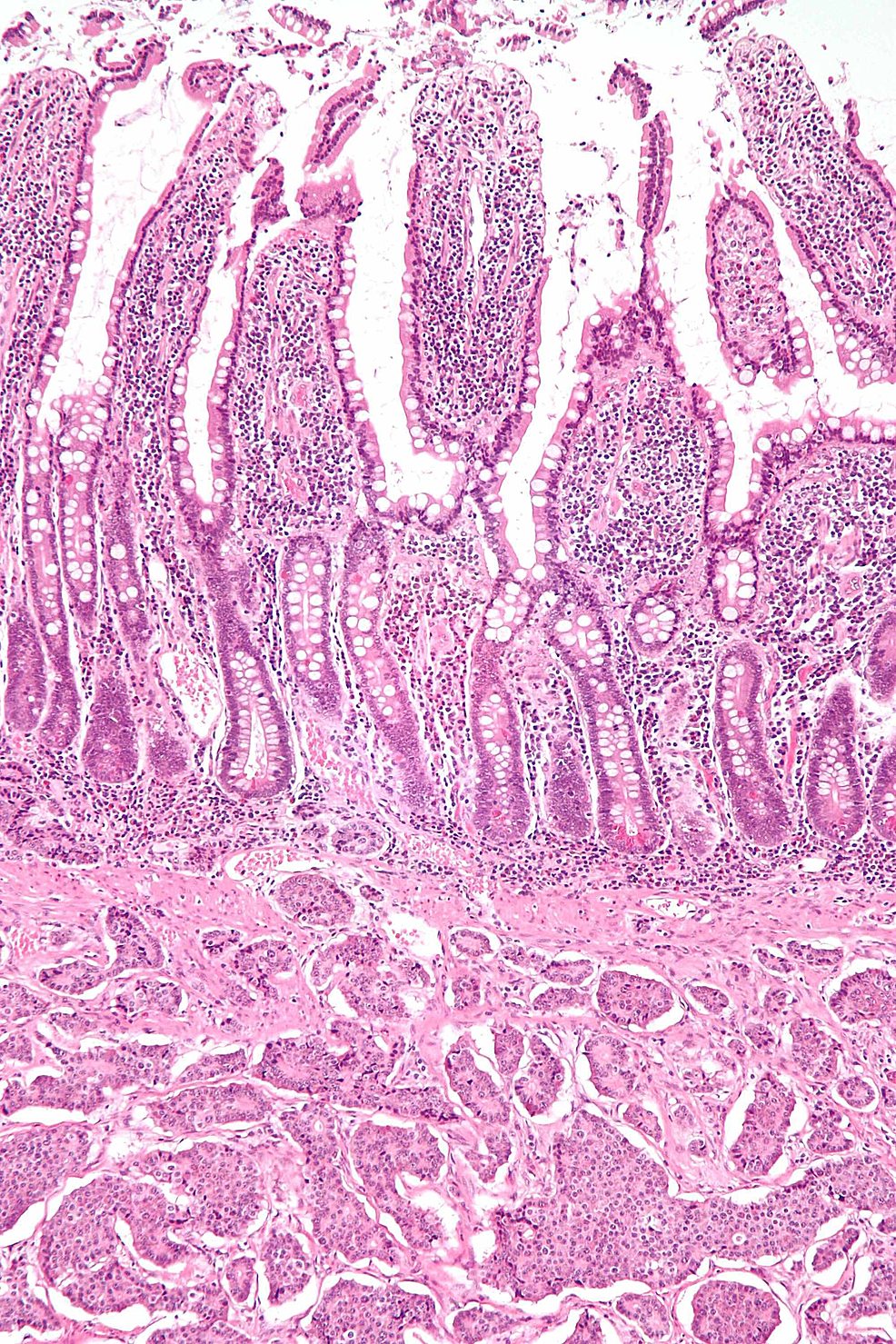 Histopathology-of-a-neuroendocrine-tumor-of-the-small-bowel-(H&E-stain)
