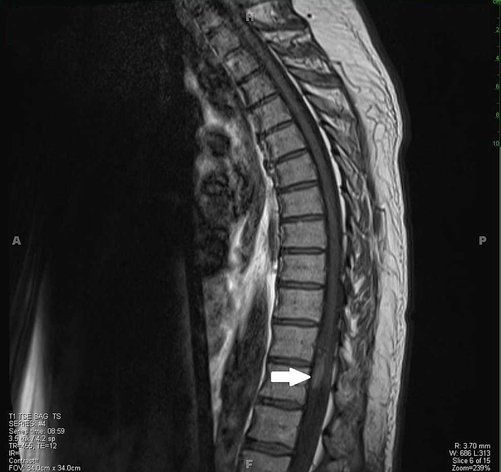 Cureus | A Patient with an Intradural Tumor: An Unexpected Finding