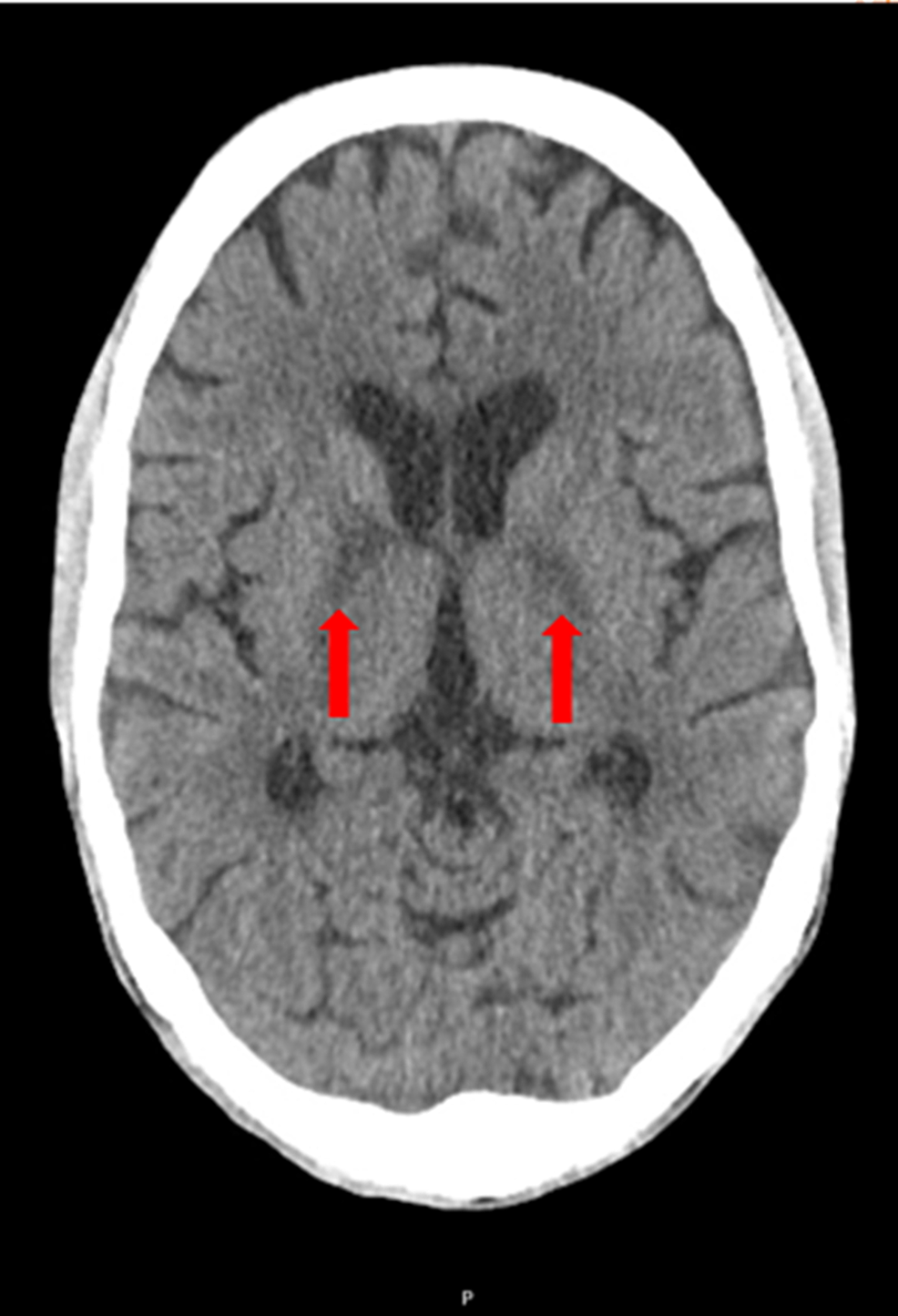 CT-of-the-brain-without-contrast