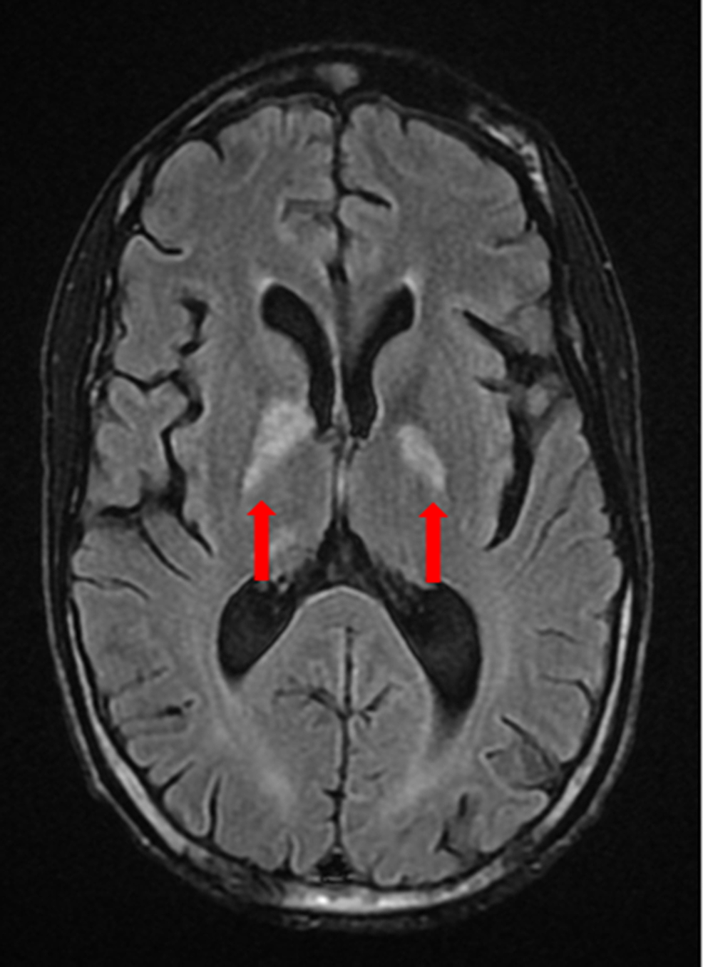 IRM du cerveau avec et sans contraste