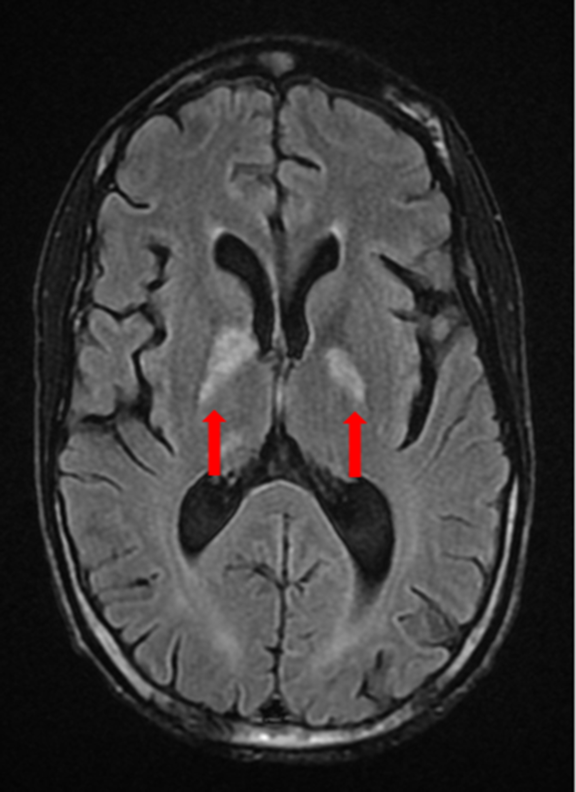 Vasculitis Mri Brain