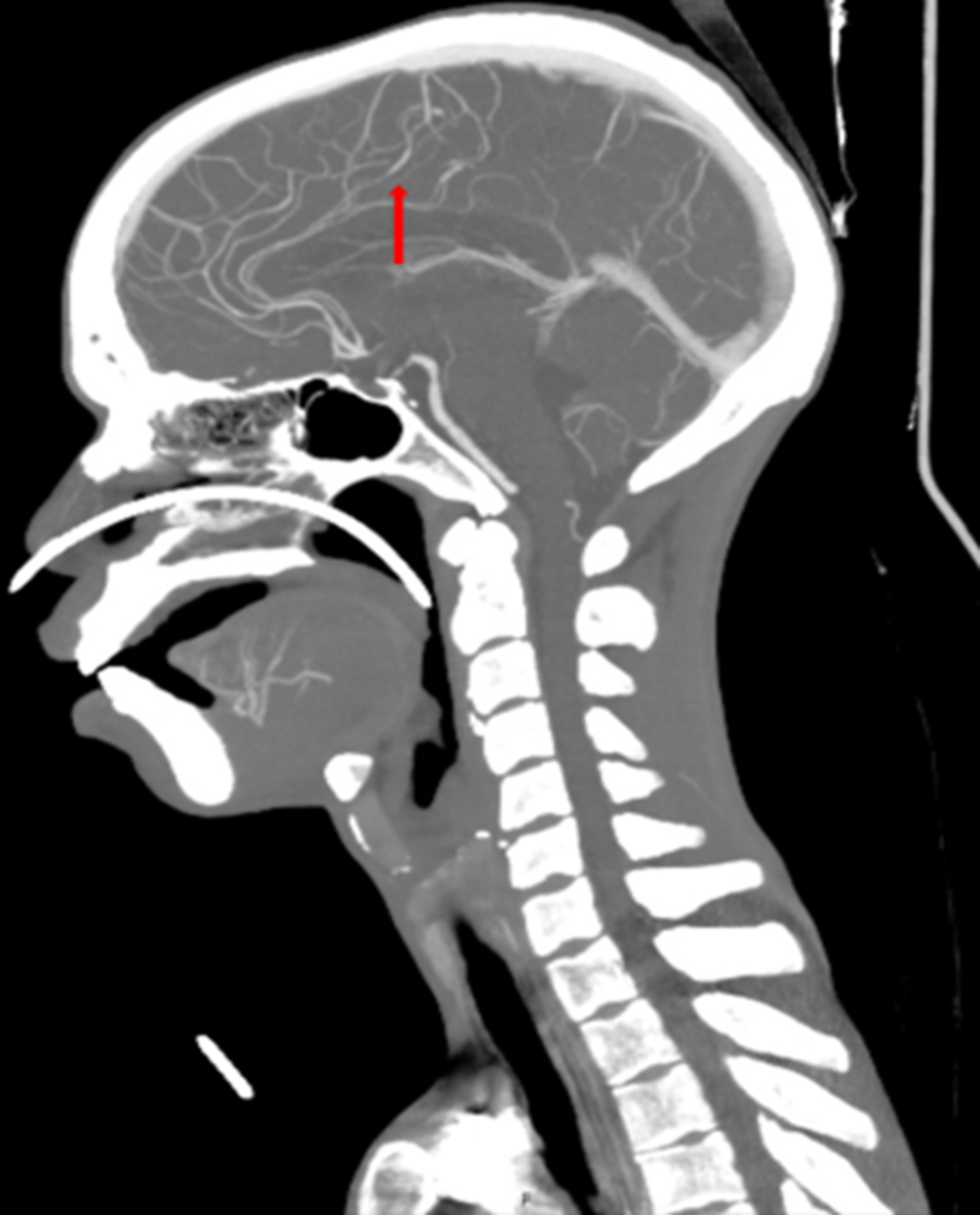 Cureus | Zoster Sine Herpete Masquerading as Central Nervous System