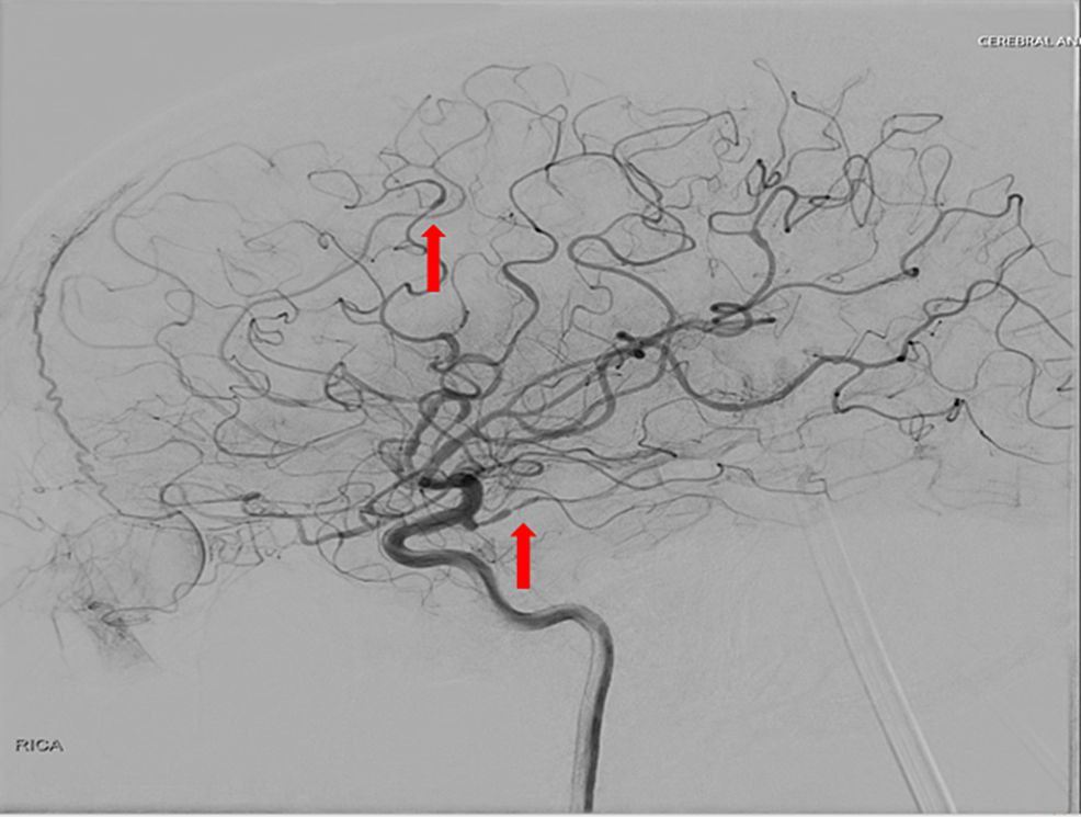 hagyományos-agyi angiográfia