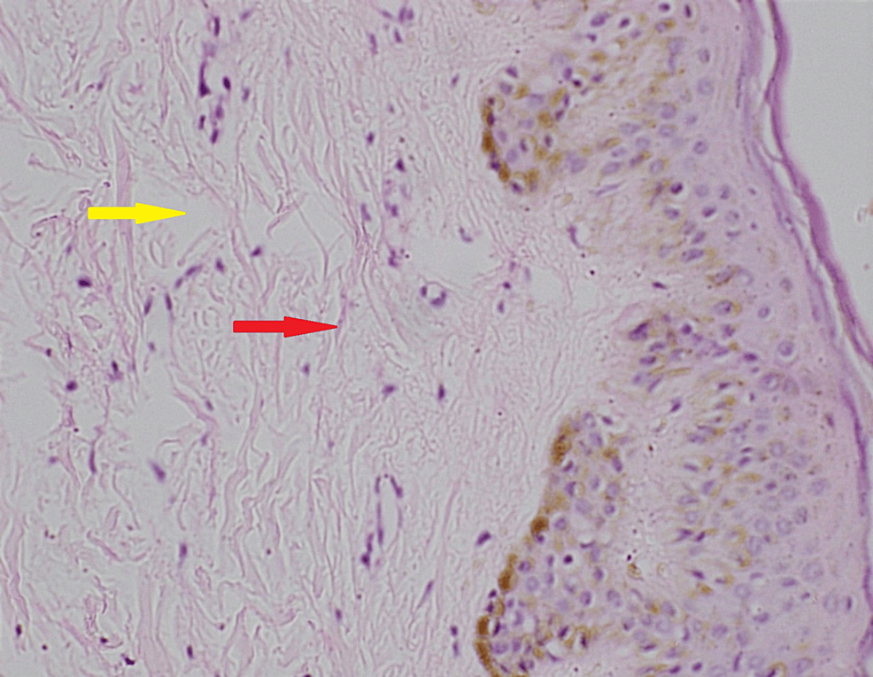 Cureus | Scleredema Diabeticorum: A Rare Metabolic Connective Tissue ...