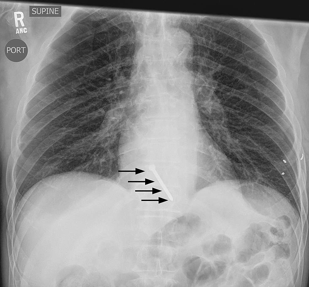 Self-inflicted Cardiac Injury with Nail Gun Without Hemodynamic ...