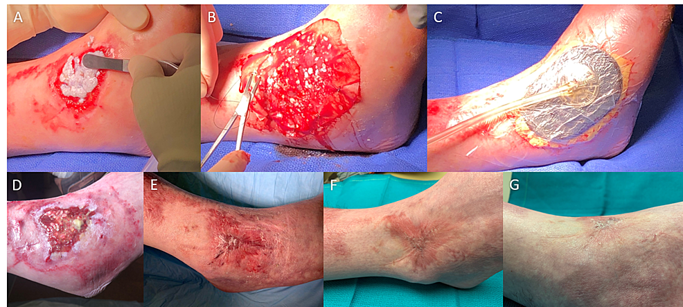 Autologous-homologous-skin-construct-(AHSC)-application,-dressing,-and-wound-closure