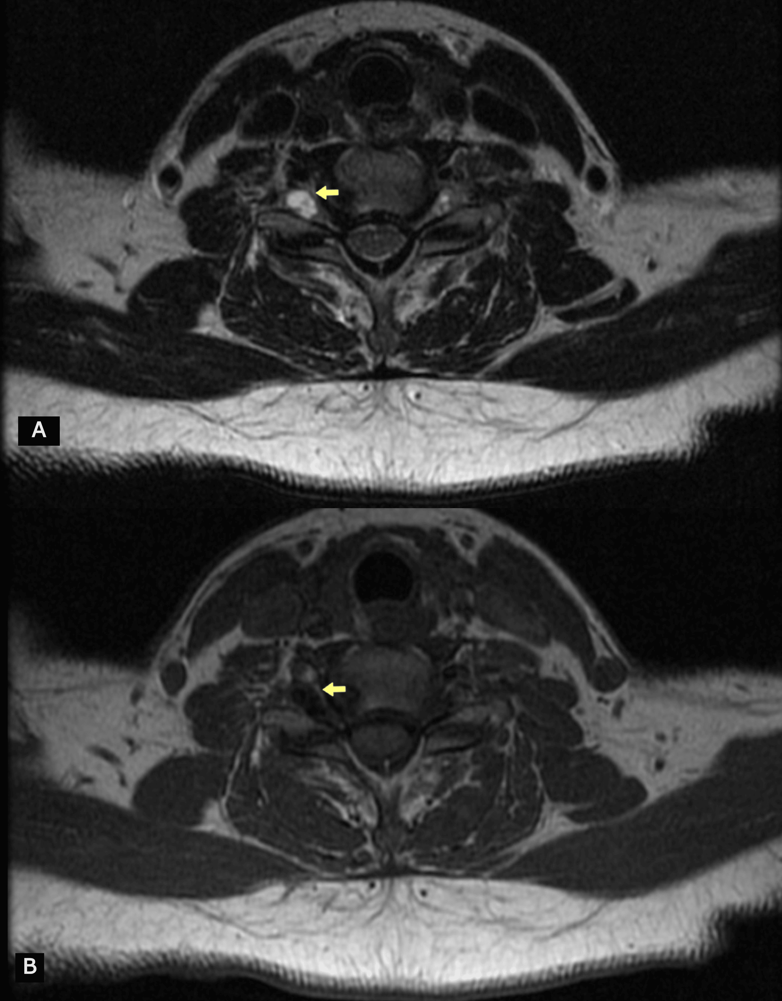 Successful Conservative Management Of A Patient With Symptomatic