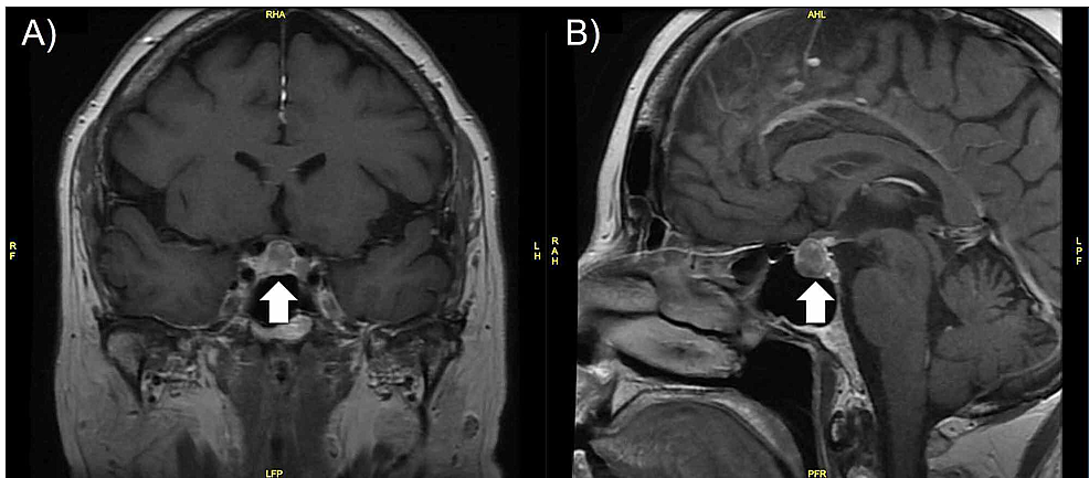 Cureus | Pituitary Metastasis of Pulmonary Large Cell Neuroendocrine ...