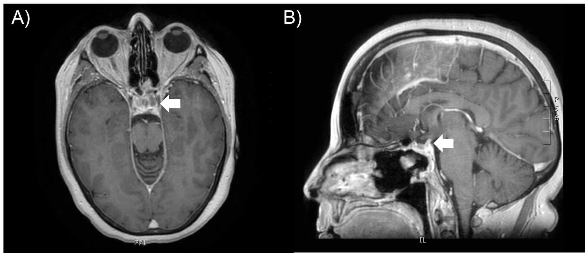 Mri Of Pituitary Gland 0364