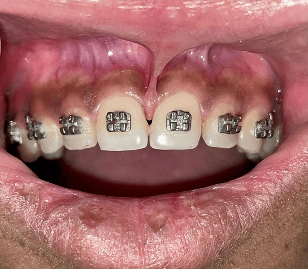 Cureus | Conventional Scalpel Technique for Frenectomy During Orthodontic  Treatment: A Case Report | Article