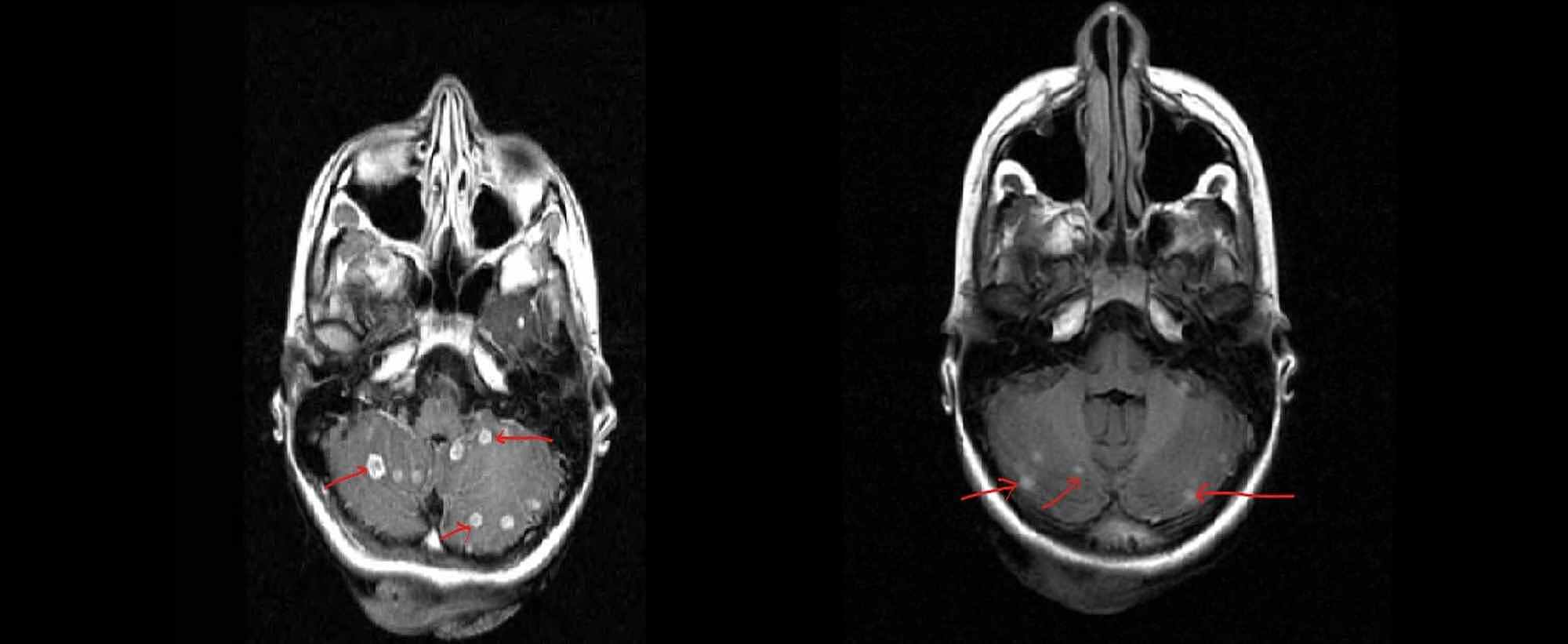 Cureus | Multiple Intracranial Tuberculomas with an Intra-medullary ...