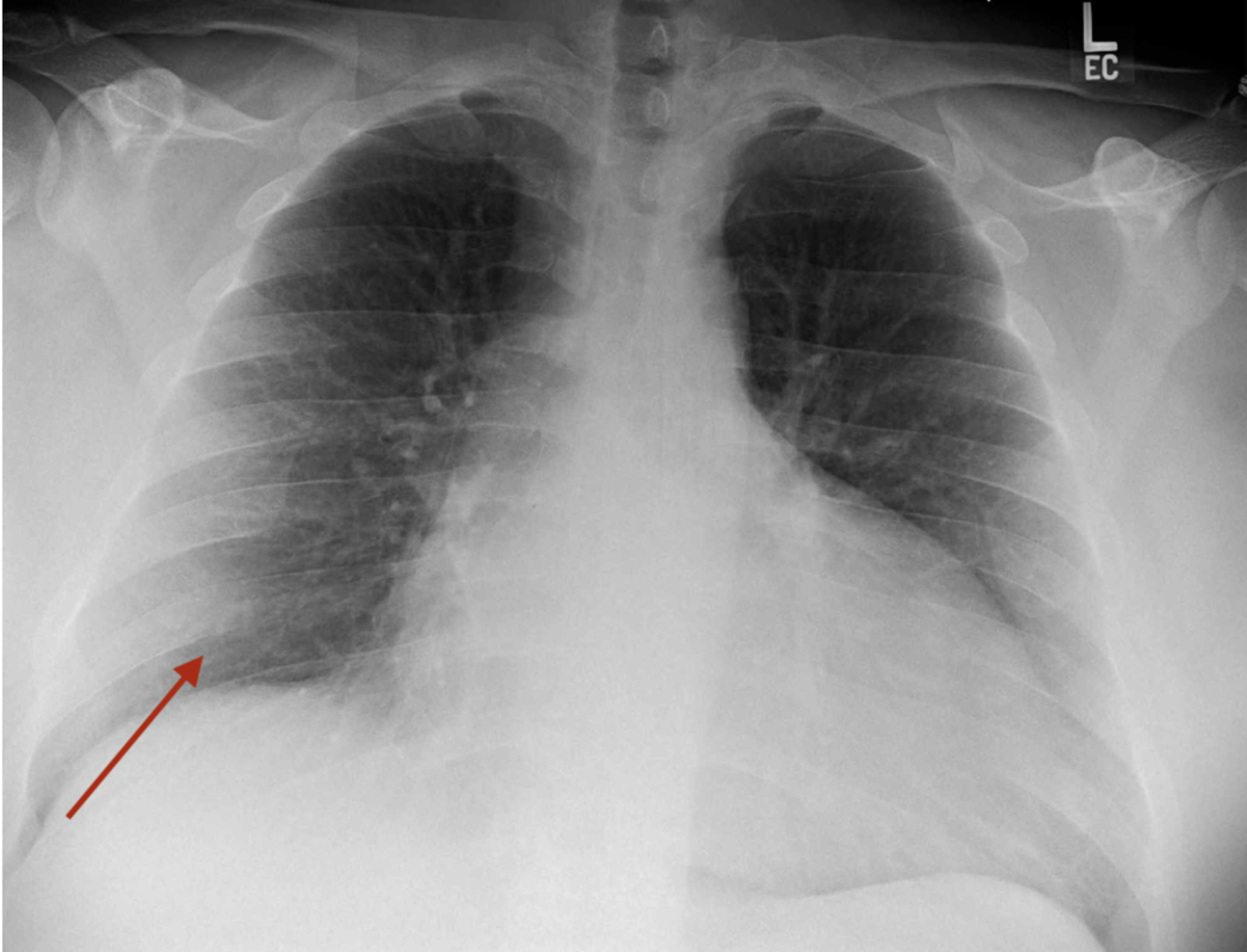 Cureus | Unexpected Reduced Biventricular Ejection Fraction in a ...