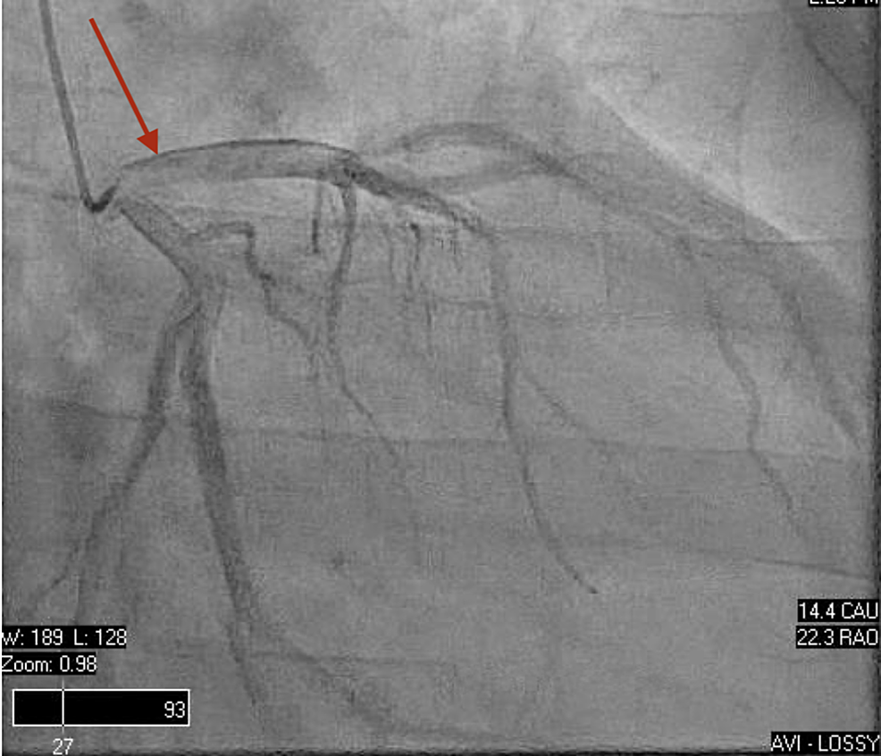 Cureus Unexpected Reduced Biventricular Ejection Fraction in a