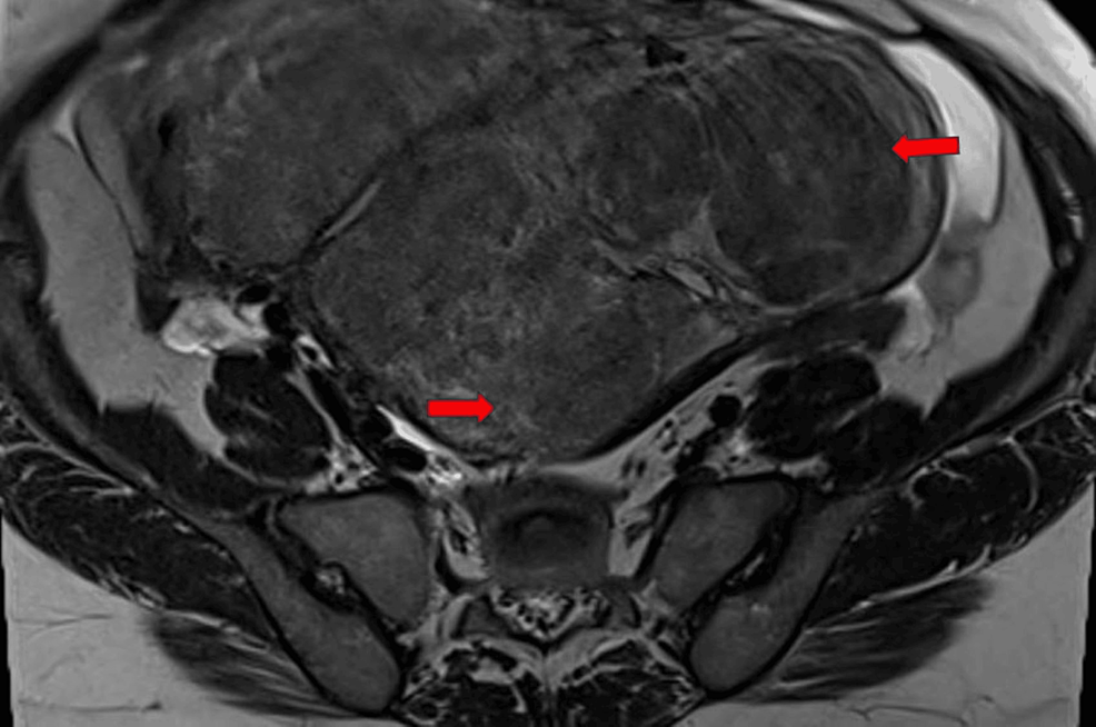 Diffuse Uterine Leiomyomatosis: A Rare Case Of Symmetrically Enlarged ...