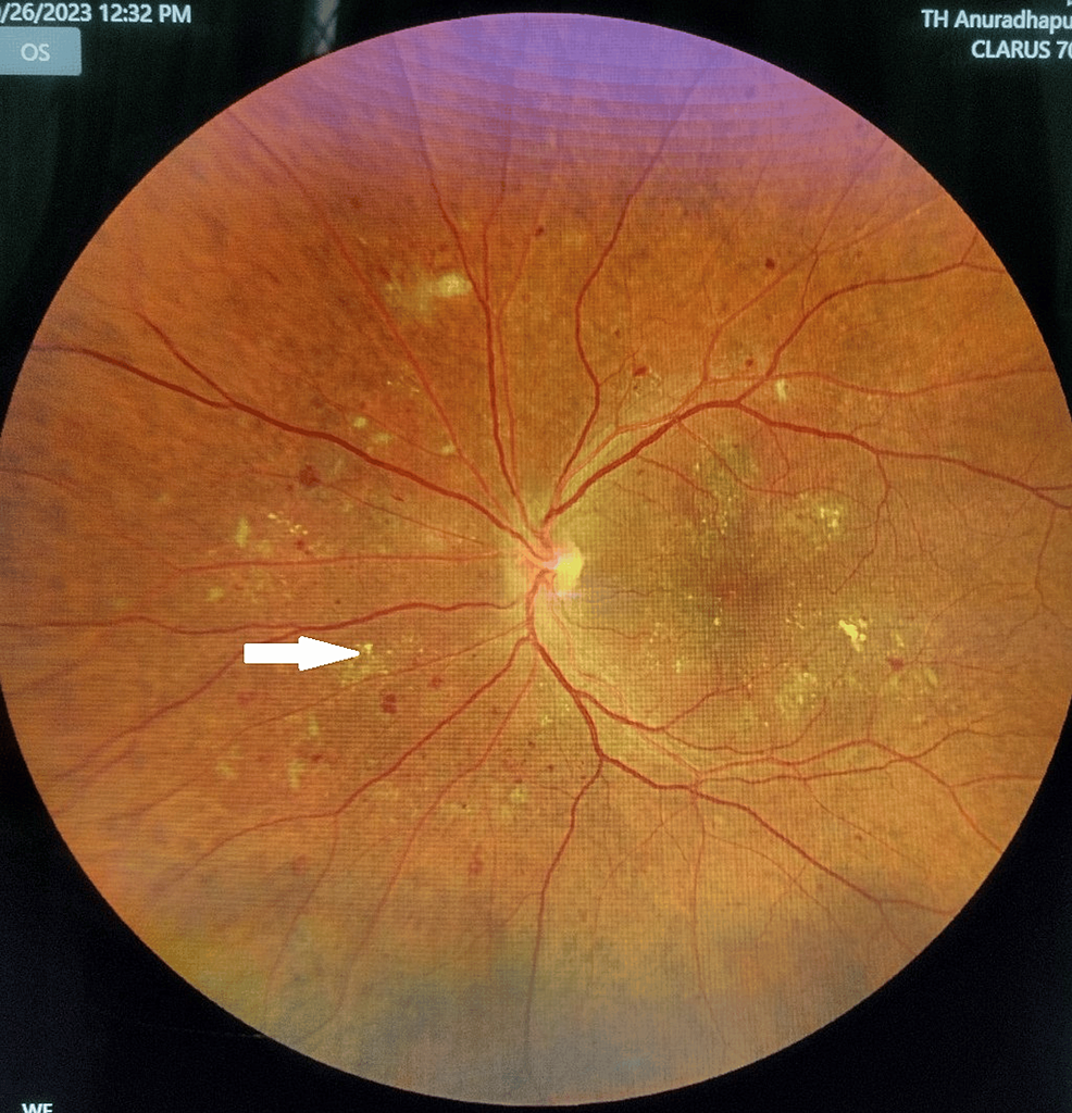 Cureus | Scleredema Diabeticorum: A Rare Metabolic Connective Tissue ...