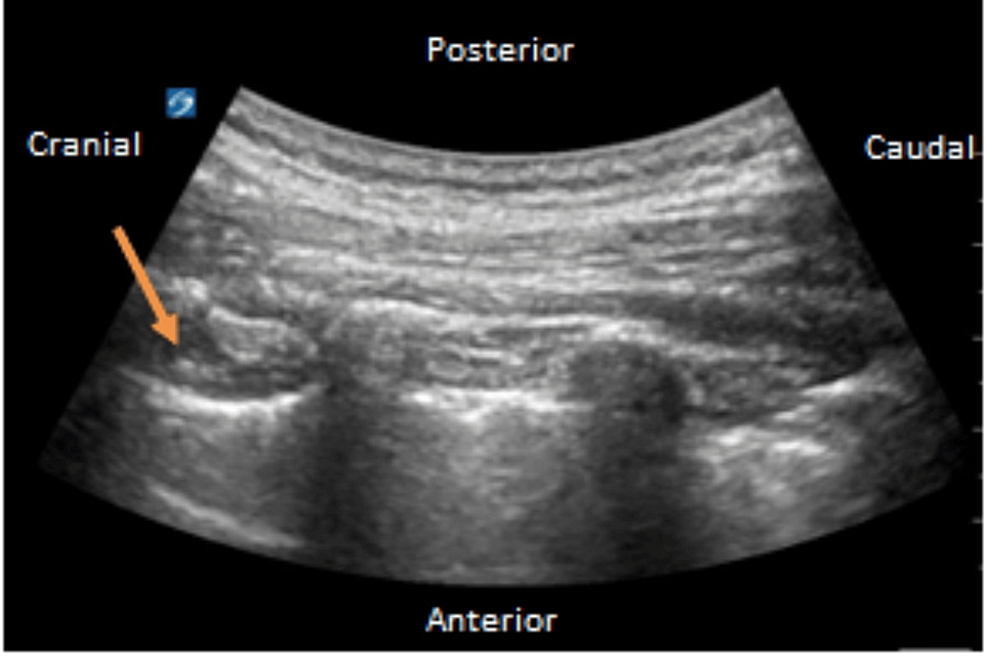 Ultrasound-guided-paravertebral-catheter-placement-with-convex-probe