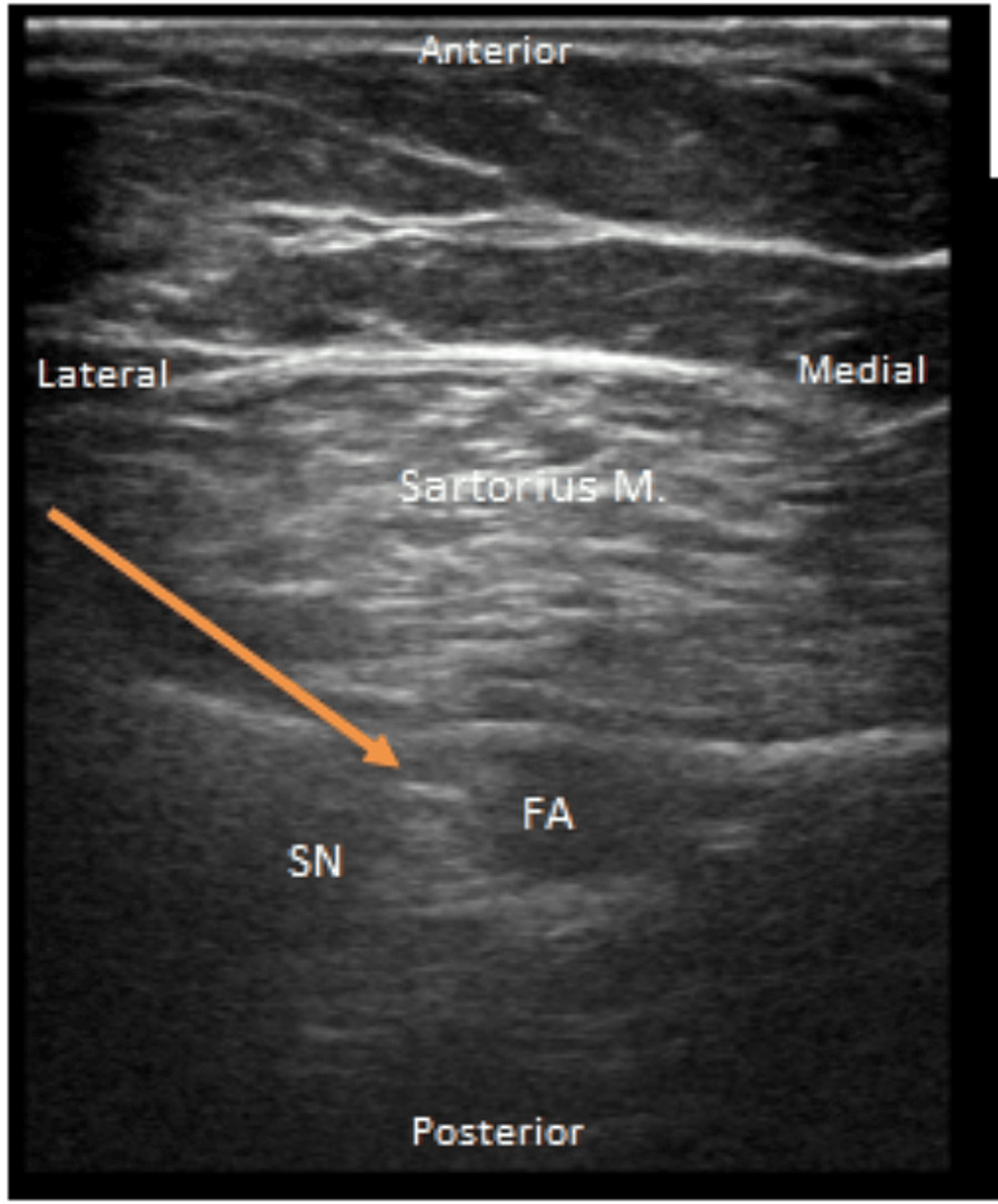 Ultrasound-guided-right-adductor-canal-catheter-placement-with-linear-probe