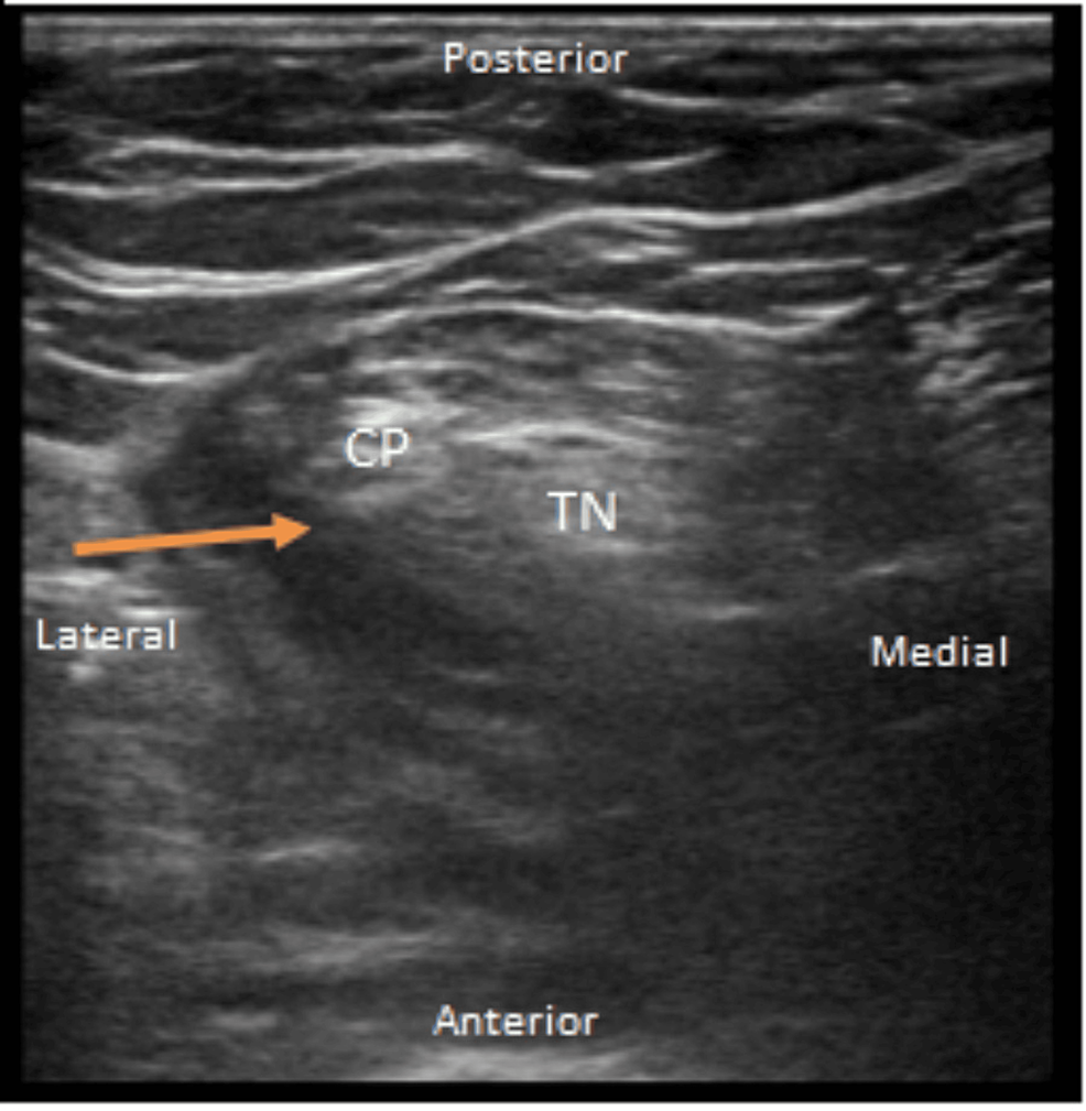 Ultrasound-guided-right-popliteal catheter-placement-with-linear-probe