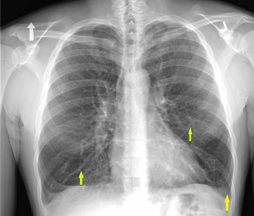 Cureus Mycoplasma Pneumoniae Induced Rash and Mucositis with
