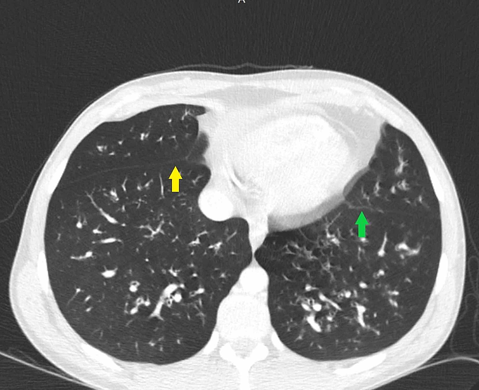Cureus Mycoplasma Pneumoniae Induced Rash and Mucositis with