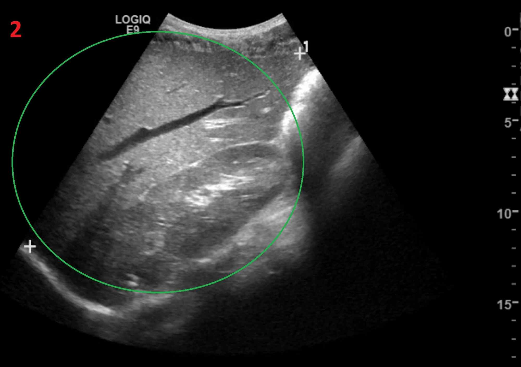 Enlarged Liver Ultrasound
