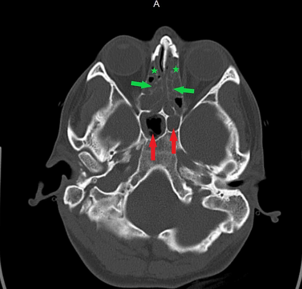 Cureus Mycoplasma Pneumoniae Induced Rash and Mucositis with