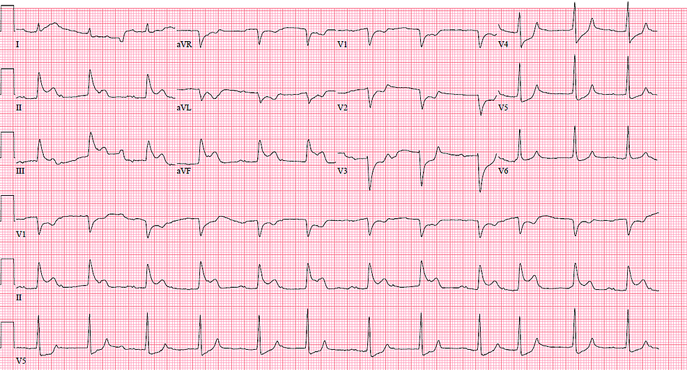 Cureus Recurrent ST Elevation Myocardial Infarction from