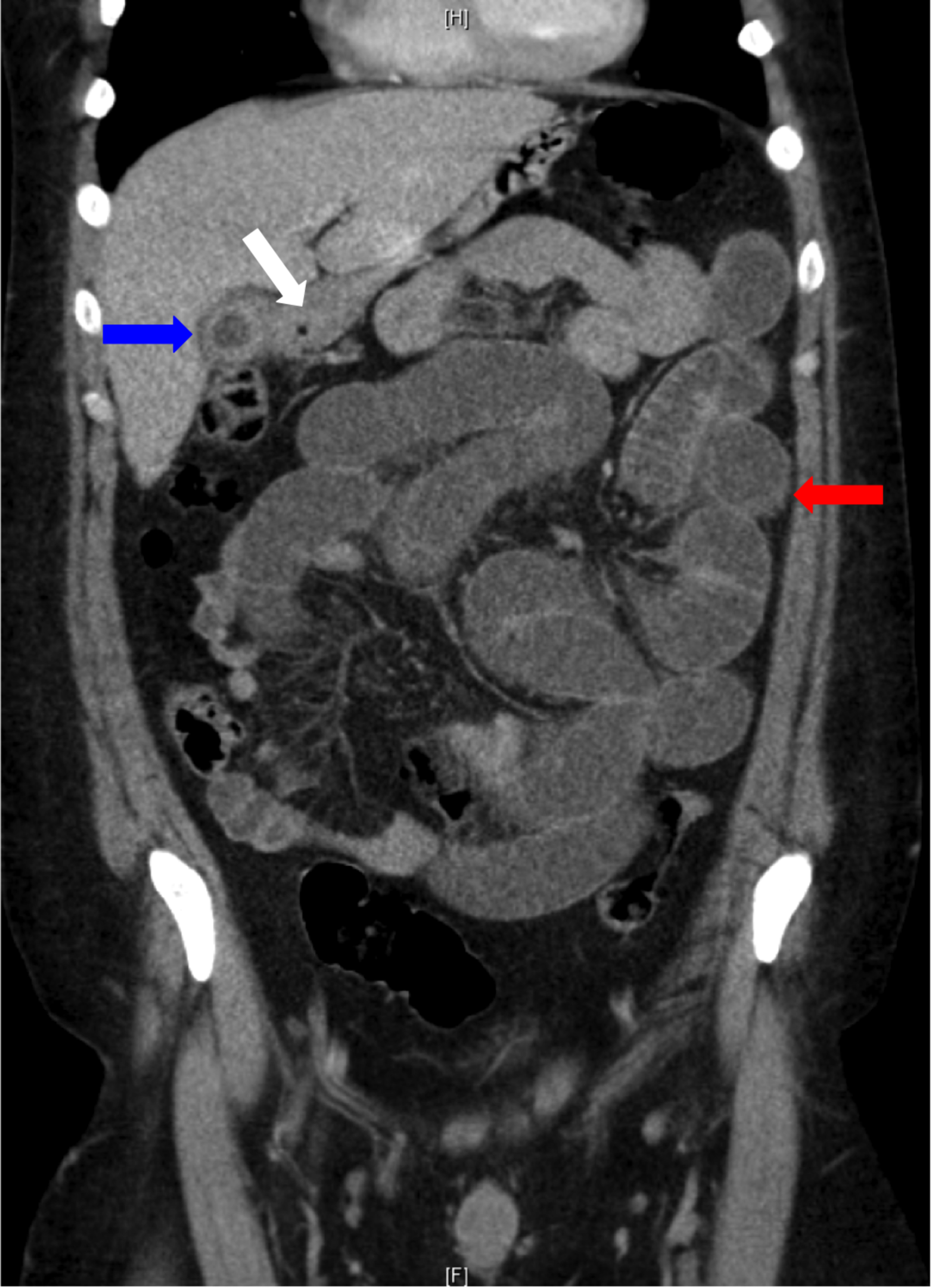 Ileus CT Scan